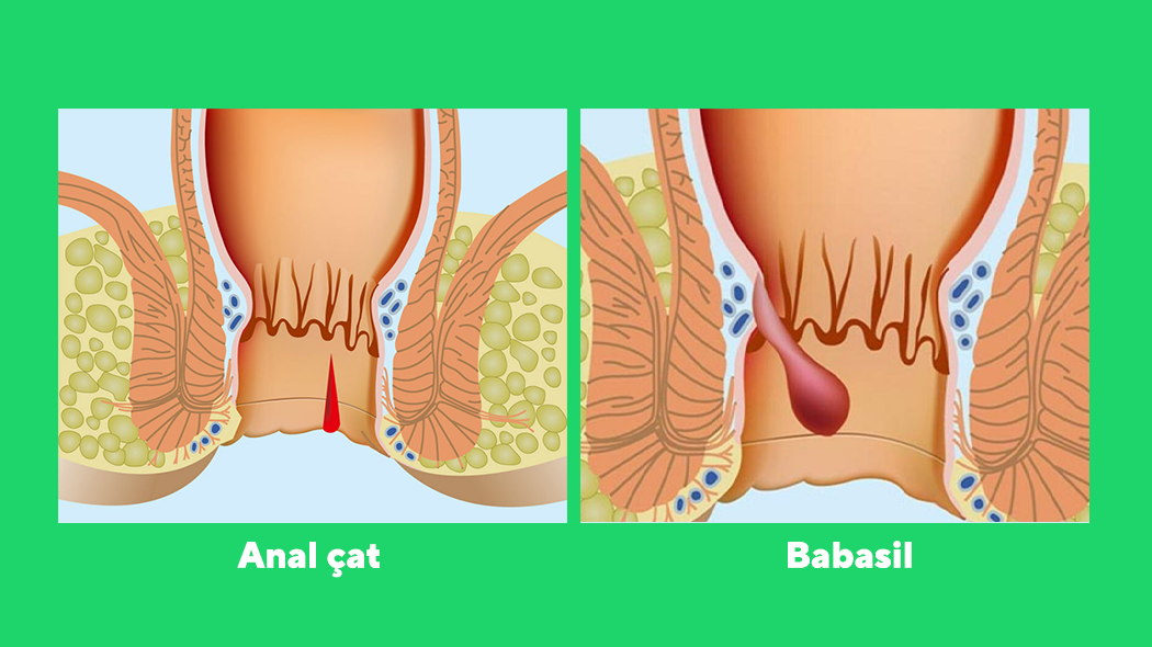 Bağırsaq çatının təbii müalicəsi | Anal çat və babasilin müalicəsi